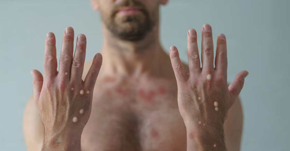 ആലിംഗനവും ഒത്തുചേരലും അപകടമാകാം; എംപോക്സ് കേസുകൾ വർധിക്കുന്നതായി മുന്നറിയിപ്പ്